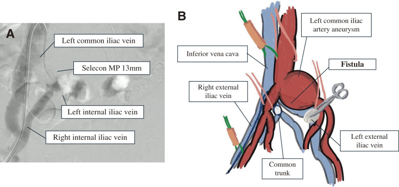 Left Common Iliac Artery Aneurysm Rupture to an Iliac Vein with a Venous Anomaly: A Case Report.