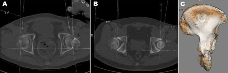 Hemiarthroplasty for Hip Fracture in Down Syndrome: A Retrospective Series of Five Cases.