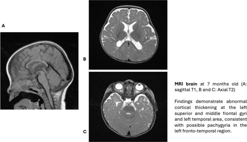 Favorable response to ketogenic diet therapy in a patient with DYNC1H1-related epilepsy