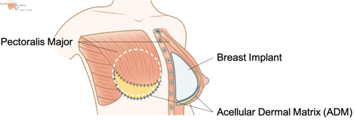Updates on Breast Reconstruction: Surgical Techniques, Challenges, and Future Directions.