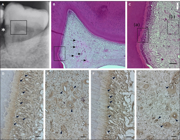 Possible Involvement of X-Box Binding Protein-1 in the Onset of Pulpitis.