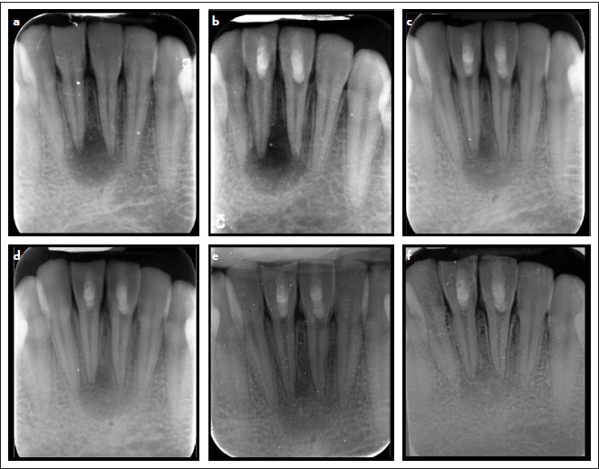 Regenerative Treatment of Mature Teeth with Pulp Necrosis and Apical Periodontitis Using Biodentine Compared with MTA: Randomized Controlled Clinical Trial.