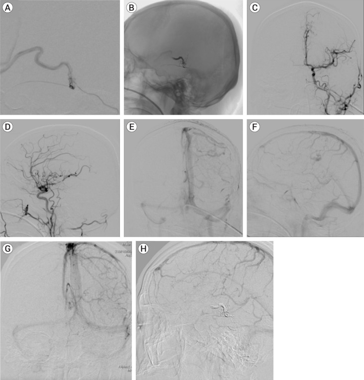 Convexity dural arteriovenous fistula with Sylvian-Labbé collateral pattern: A case report.