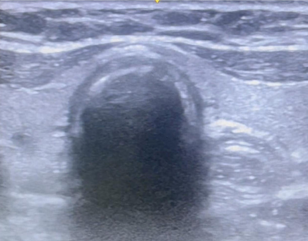 Focus on POCUS: Identification of Early Successful Intubation by Point-of-Care Ultrasound Versus End-Tidal Carbon Dioxide: A Prospective Comparative Study.