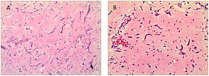 Neurological complications of left atrial myxoma: a case report on stroke with left atrial myxoma and postoperative brain metastasis and cerebral aneurysm.