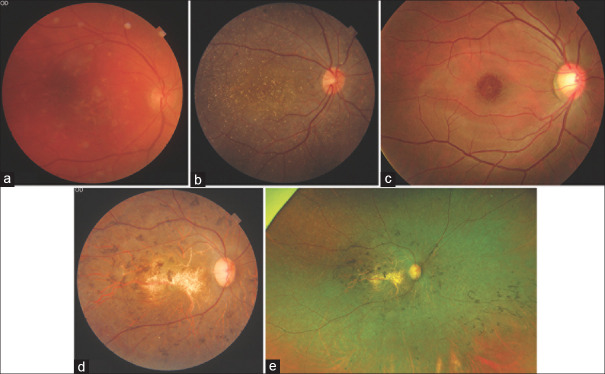 Utility of multimodal imaging in the clinical diagnosis of inherited retinal degenerations.