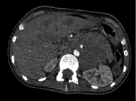 Primary Esophageal Rhabdomyosarcoma: An Exceptionally Rare Cause of Pediatric Dysphagia.