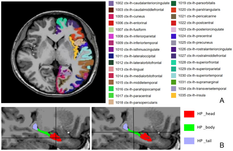 Exploring Cortical and Hippocampal Changes in Temporal Lobe Epilepsy Using Automated MRI Segmentation Techniques.