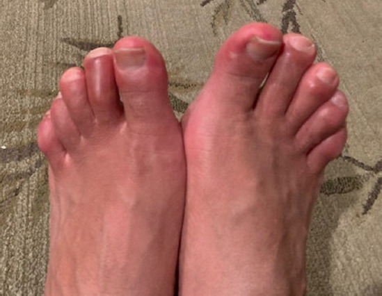 MRI Findings of Bilateral Anterior Tarsal Tunnel Syndrome - A Case Report.