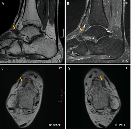 MRI Findings of Bilateral Anterior Tarsal Tunnel Syndrome - A Case Report.