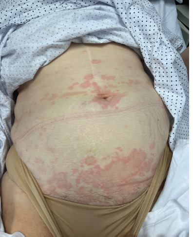 [Target lesions and fever, an unexpected microorganism].