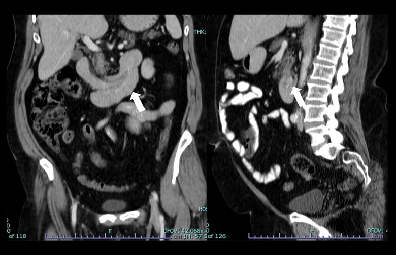 Adult Intussusception in Jordan: Demographics, Clinical Features, and Outcomes from a Tertiary Hospital.