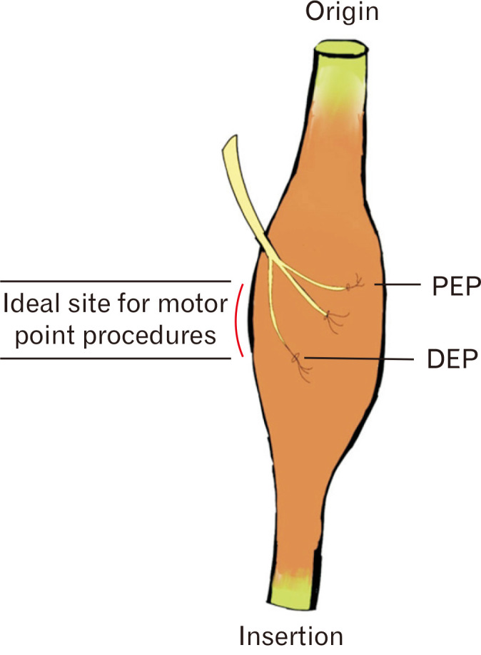 Localizing motor entry points of adductor muscles of thigh for motor point procedures in the treatment of adductor spasticity.