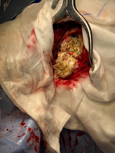 Complete resection of a giant epidermoid cyst of the occipital bone: case report and systematic review.