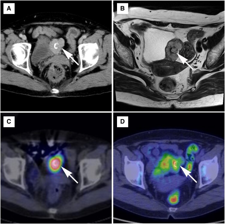 Incidentally Detected Urinary Bladder Paraganglioma.