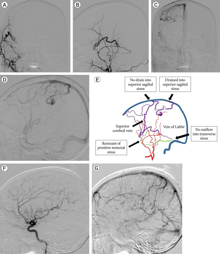 Convexity dural arteriovenous fistula with Sylvian-Labbé collateral pattern: A case report.