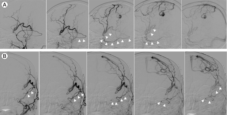 Convexity dural arteriovenous fistula with Sylvian-Labbé collateral pattern: A case report.