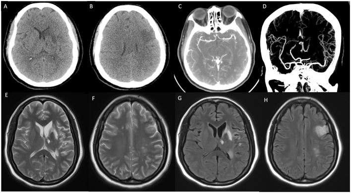 Neurological complications of left atrial myxoma: a case report on stroke with left atrial myxoma and postoperative brain metastasis and cerebral aneurysm.