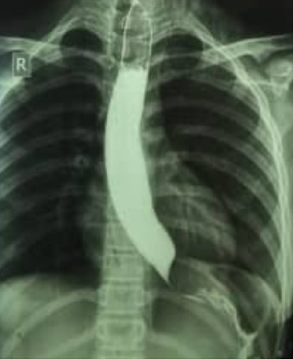 Primary Esophageal Rhabdomyosarcoma: An Exceptionally Rare Cause of Pediatric Dysphagia.