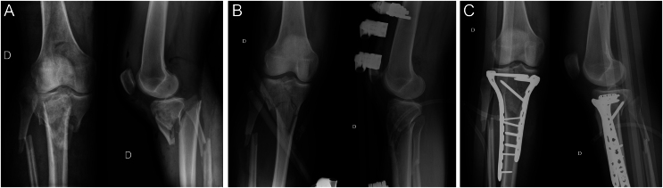 Fixation of tibial plateau fracture - risk factors for developing infection: a narrative review.
