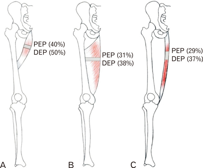 Localizing motor entry points of adductor muscles of thigh for motor point procedures in the treatment of adductor spasticity.