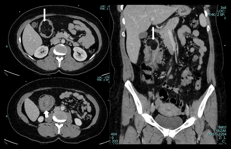 Adult Intussusception in Jordan: Demographics, Clinical Features, and Outcomes from a Tertiary Hospital.