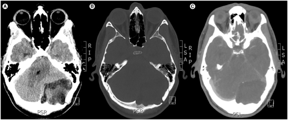 Complete resection of a giant epidermoid cyst of the occipital bone: case report and systematic review.