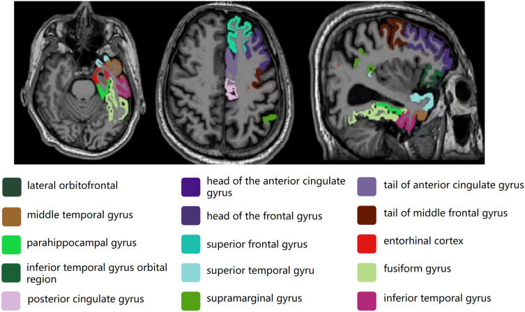 Exploring Cortical and Hippocampal Changes in Temporal Lobe Epilepsy Using Automated MRI Segmentation Techniques.
