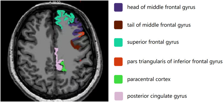 Exploring Cortical and Hippocampal Changes in Temporal Lobe Epilepsy Using Automated MRI Segmentation Techniques.