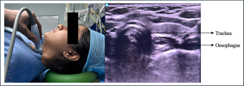 Focus on POCUS: Identification of Early Successful Intubation by Point-of-Care Ultrasound Versus End-Tidal Carbon Dioxide: A Prospective Comparative Study.