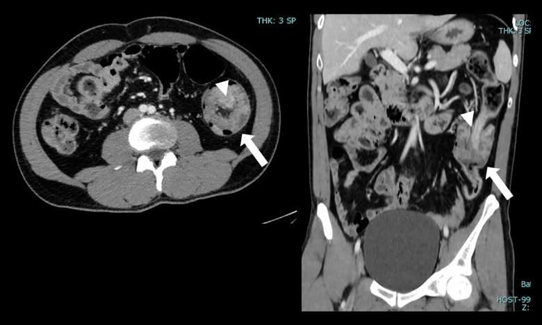 Adult Intussusception in Jordan: Demographics, Clinical Features, and Outcomes from a Tertiary Hospital.