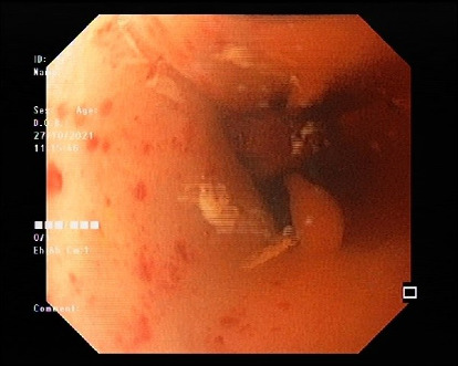 Primary Esophageal Rhabdomyosarcoma: An Exceptionally Rare Cause of Pediatric Dysphagia.