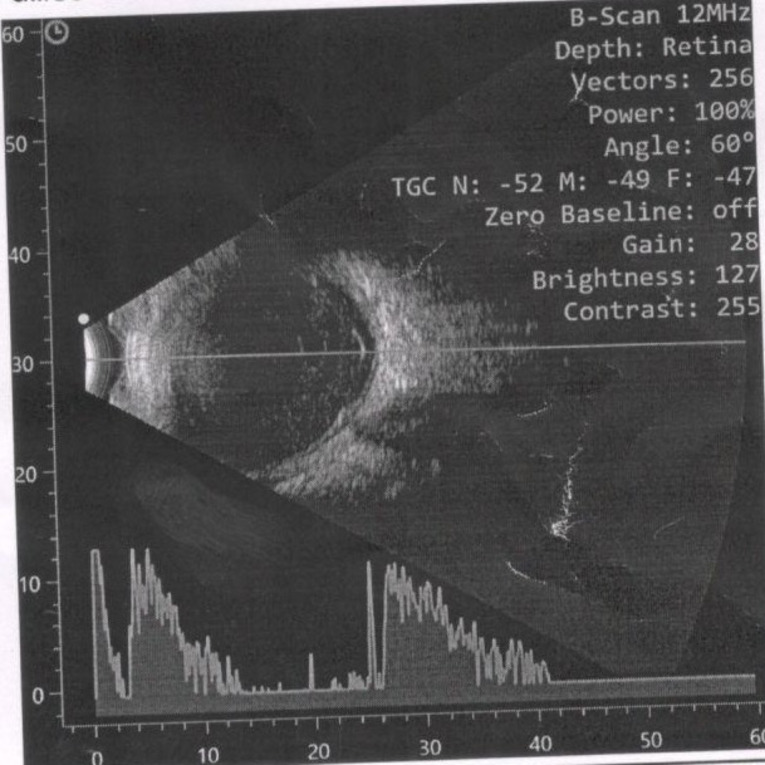 A rare case of Stenotrophomonas maltophilia endogenous endophthalmitis in pediatric age group.