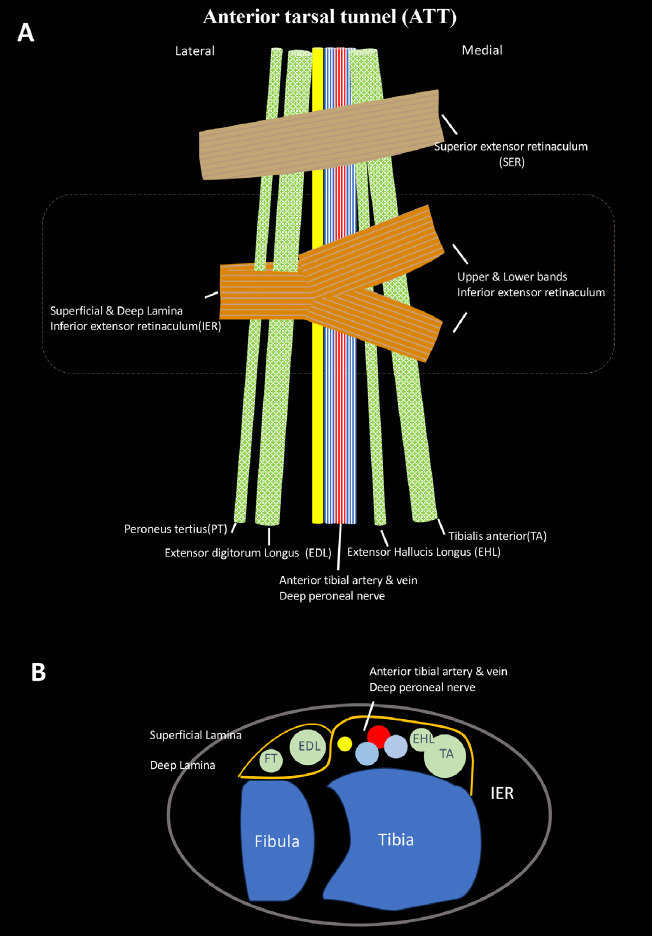 MRI Findings of Bilateral Anterior Tarsal Tunnel Syndrome - A Case Report.