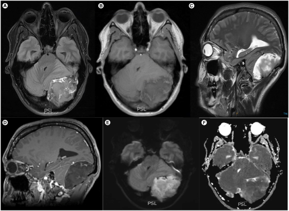 Complete resection of a giant epidermoid cyst of the occipital bone: case report and systematic review.