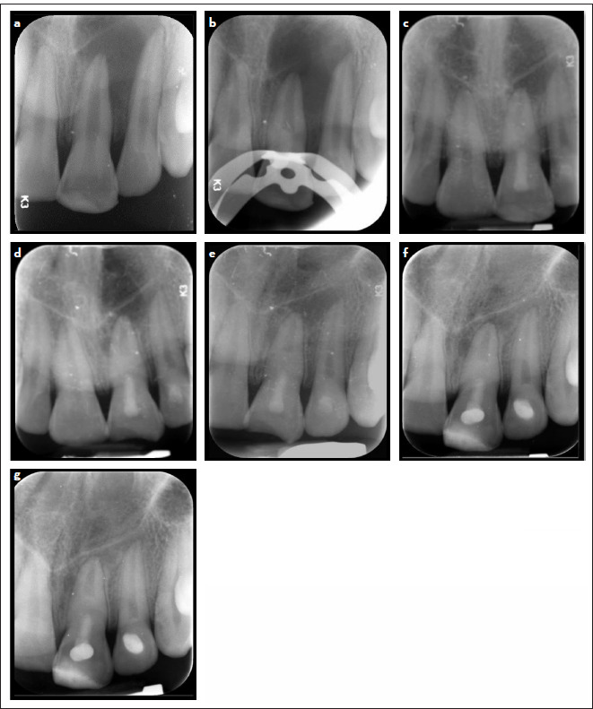 Regenerative Treatment of Mature Teeth with Pulp Necrosis and Apical Periodontitis Using Biodentine Compared with MTA: Randomized Controlled Clinical Trial.