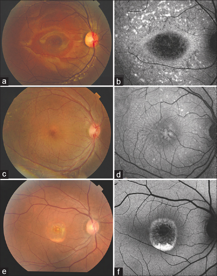 Utility of multimodal imaging in the clinical diagnosis of inherited retinal degenerations.