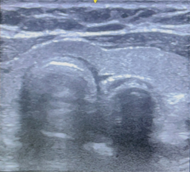Focus on POCUS: Identification of Early Successful Intubation by Point-of-Care Ultrasound Versus End-Tidal Carbon Dioxide: A Prospective Comparative Study.