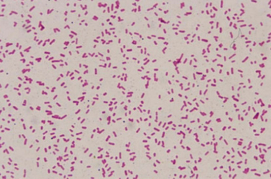 A rare case of Stenotrophomonas maltophilia endogenous endophthalmitis in pediatric age group.