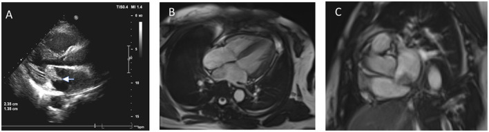 Neurological complications of left atrial myxoma: a case report on stroke with left atrial myxoma and postoperative brain metastasis and cerebral aneurysm.
