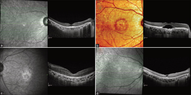 Utility of multimodal imaging in the clinical diagnosis of inherited retinal degenerations.