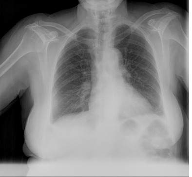 [Target lesions and fever, an unexpected microorganism].