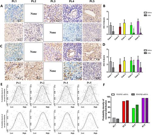 The Potential Therapeutic Targets of Anlotinib in Osteosarcoma: Characterization Based on Patient-Derived Xenografts and Next-Generation Sequencing