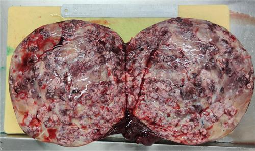 Large Myxoid Ovarian Leiomyoma: A Case Report