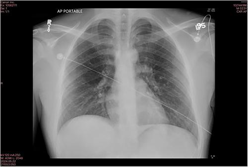 A case of spontaneous pneumomediastinum in a triathlete