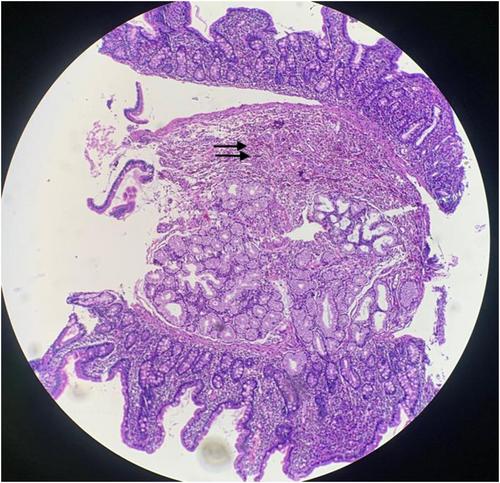 A Patient With Eosinophilic Gastroenteritis Presenting With Severe Abdominal Pain