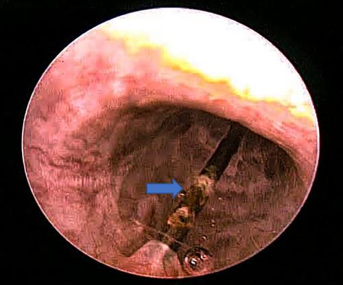 An Act of Auto-Eroticism: Self-Urethral Insertion of Sewing Needle by an Old Man—A Case Report With Literature Review