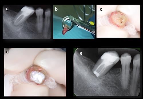 Long-Term Success of Teeth Undergoing Intentional Replantation: A Report of Two Cases