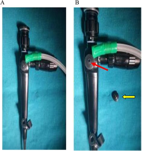 An Unusual Cause of Failure of Fiberoptic Intubation due to Continuous Suctioning: A Case Report