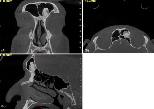 Incidental Detection of Frontal Osteoma During Pre-Rhinoplasty Imaging